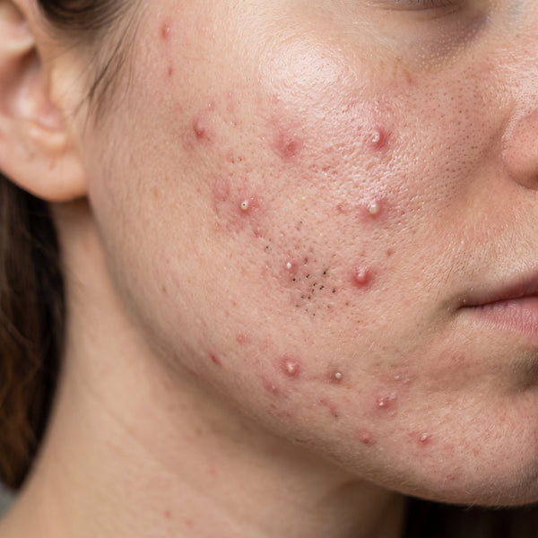 Acne Care