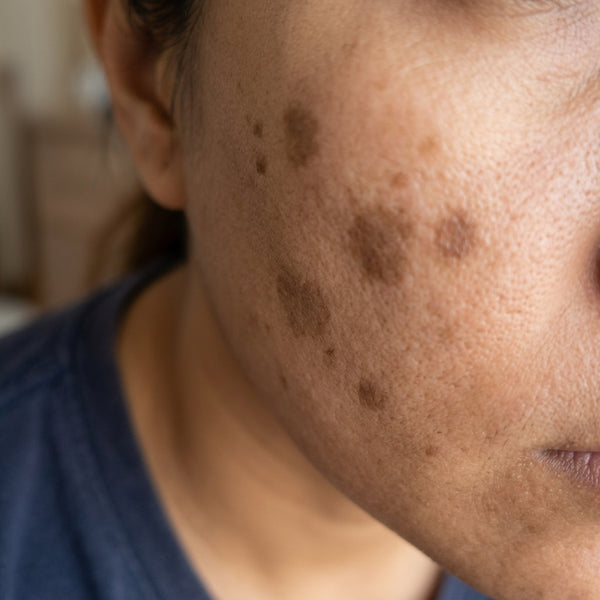 Dark Spots